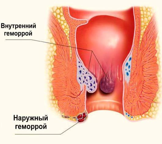 Лікування геморою лазером