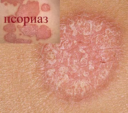 Лечение псориаза в Киеве